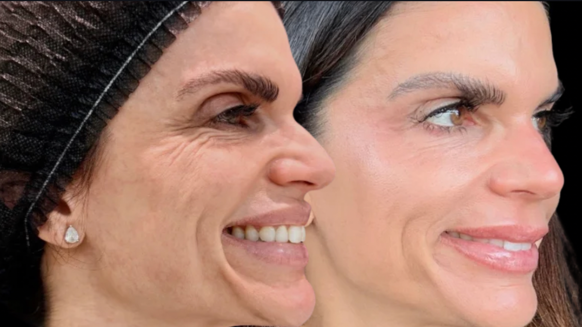Resultado antes e depois — perfil